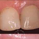 Faceta antes e depois